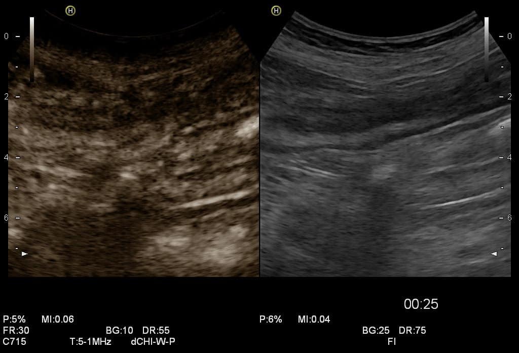 Kontrastmittel-Sonographie