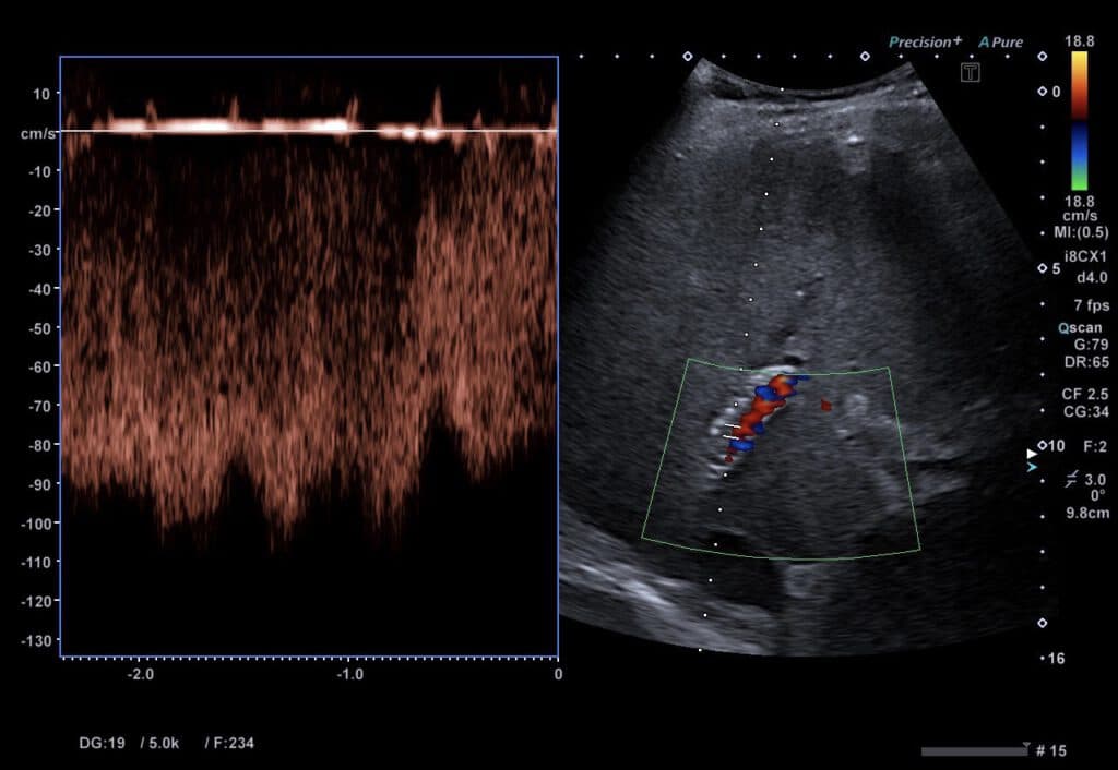 Sonographische TIPSS-Kontrolle