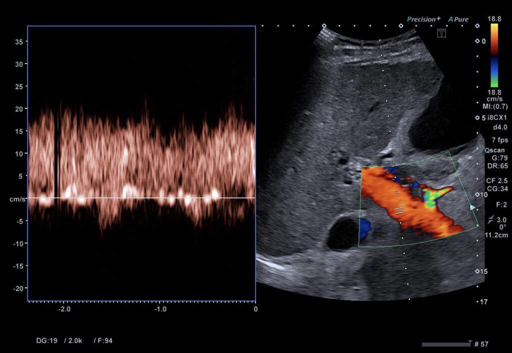 Sonographische TIPSS-Kontrolle