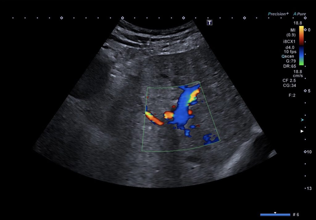 Sonographische TIPSS-Kontrolle