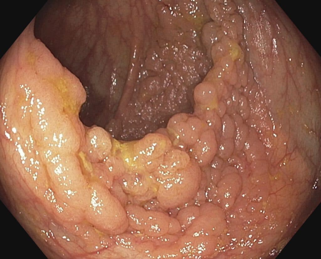 Lateral Spreading Tumor