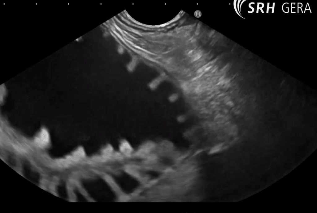 Afferent-Loop-Syndrom - Endosonographisches Bild