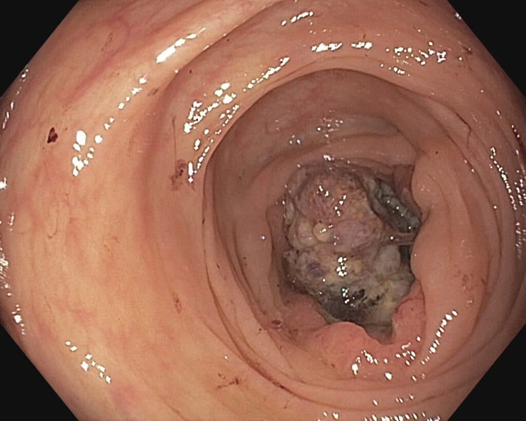 Kolonkarzinom - Endoskopische Ansicht