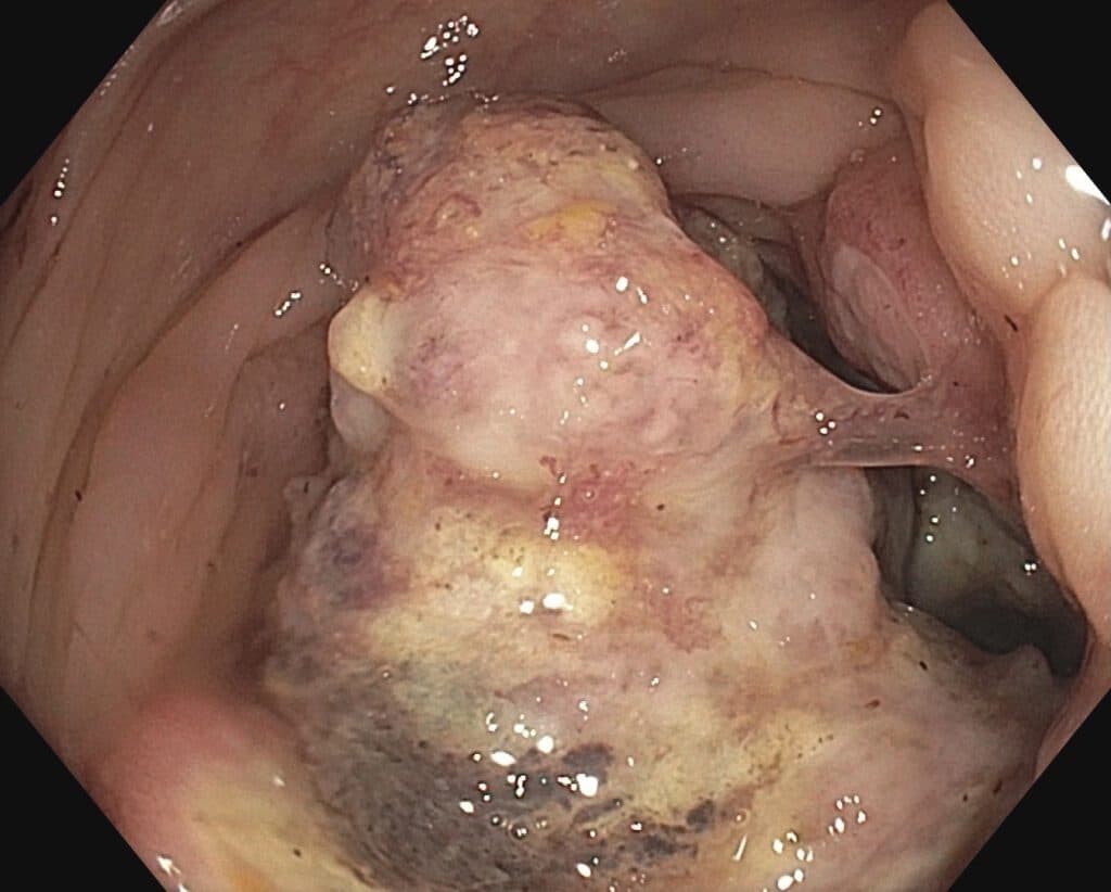 Kolonkarzinom - Endoskopische Ansicht
