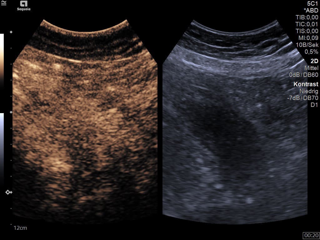 Kontrastmittel-Sonographie des Pankreastumors