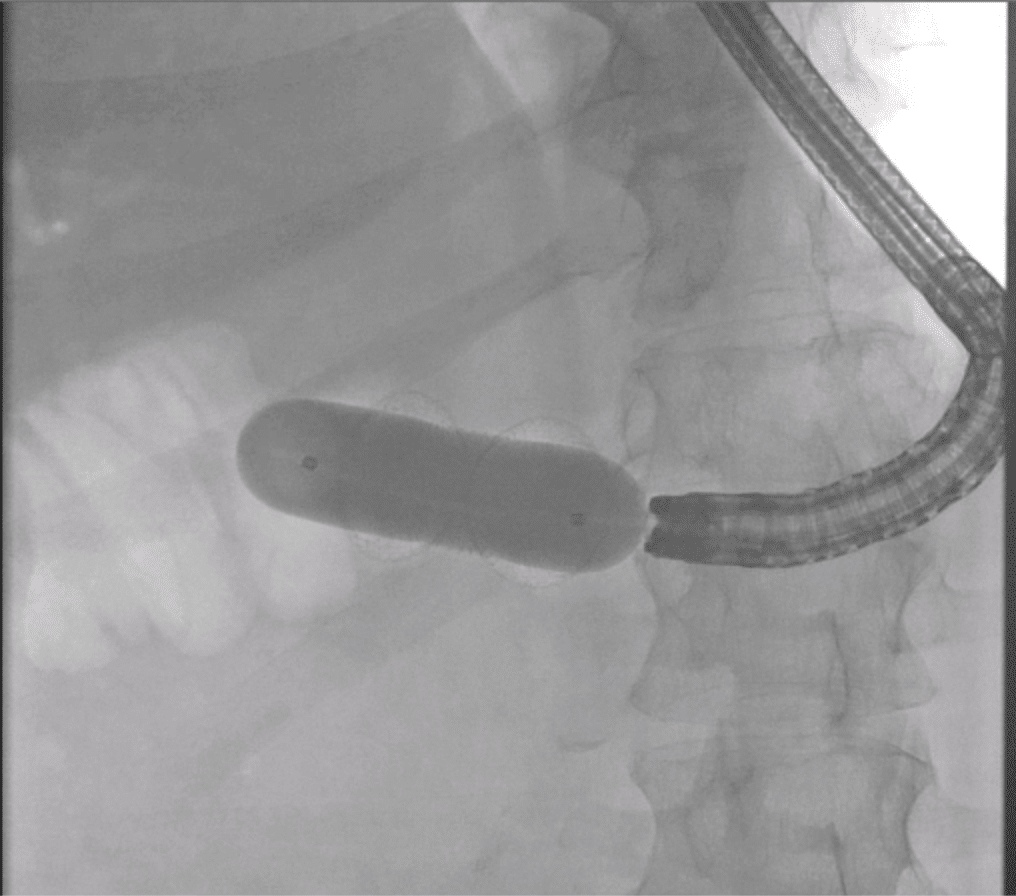 Ballondilatation des AXIOS™-Stents