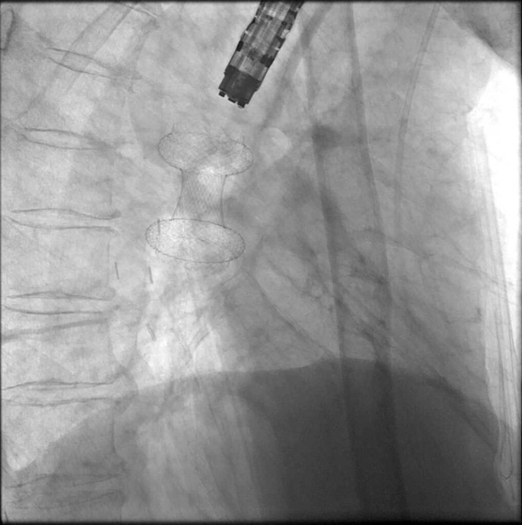 Fluoroskopie nach der Stentfreisetzung