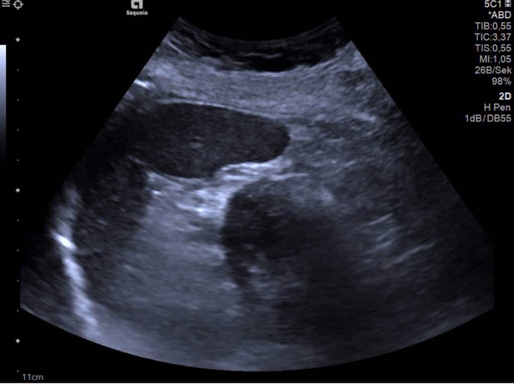 Echoarmer Tumor im Pankreas