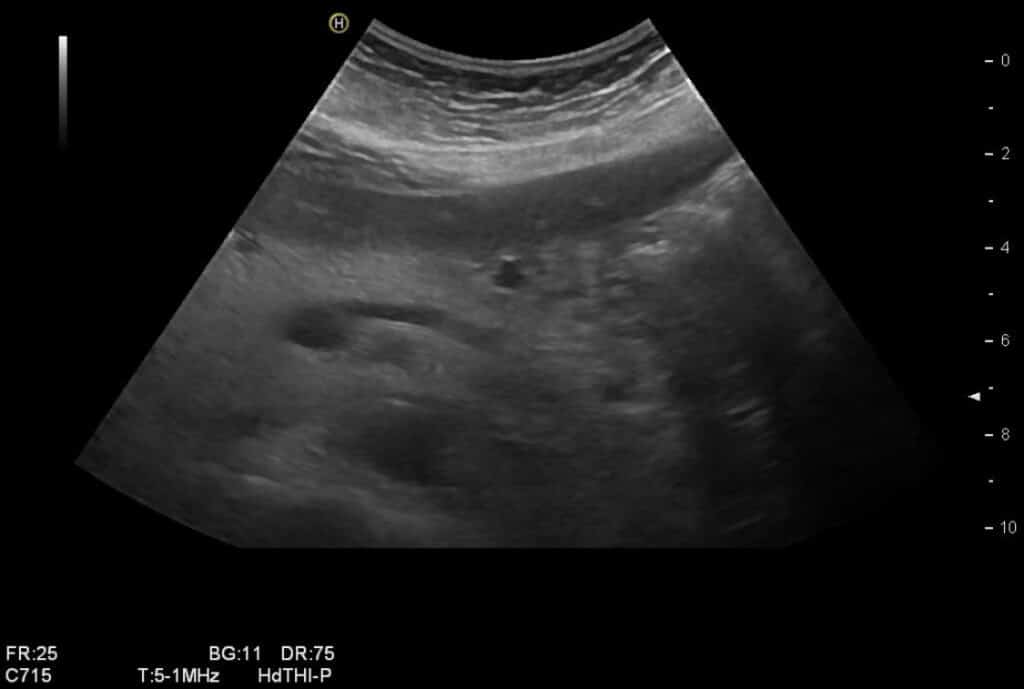 Sonographische Verlaufskontrolle nach Therapie