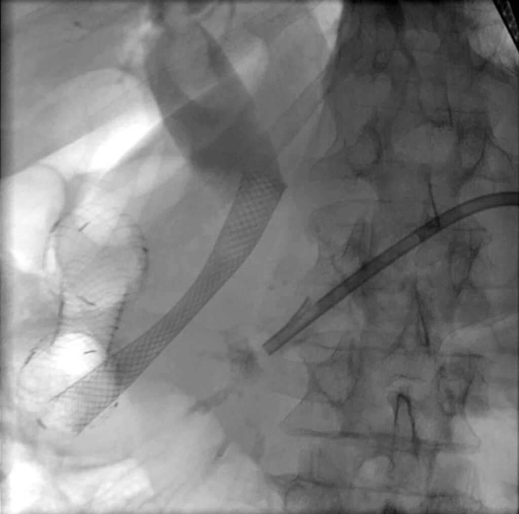 Biliärer Metallstent - Drainage des DP - intestinaler Metallstent