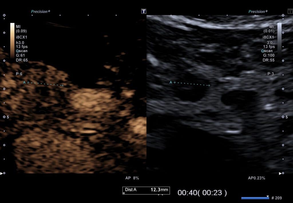 Kontrastmittel-Sonographie