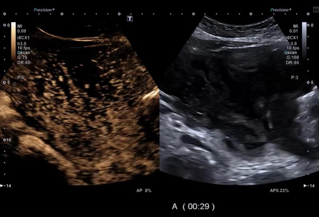 Kontrastmittel-Sonographie