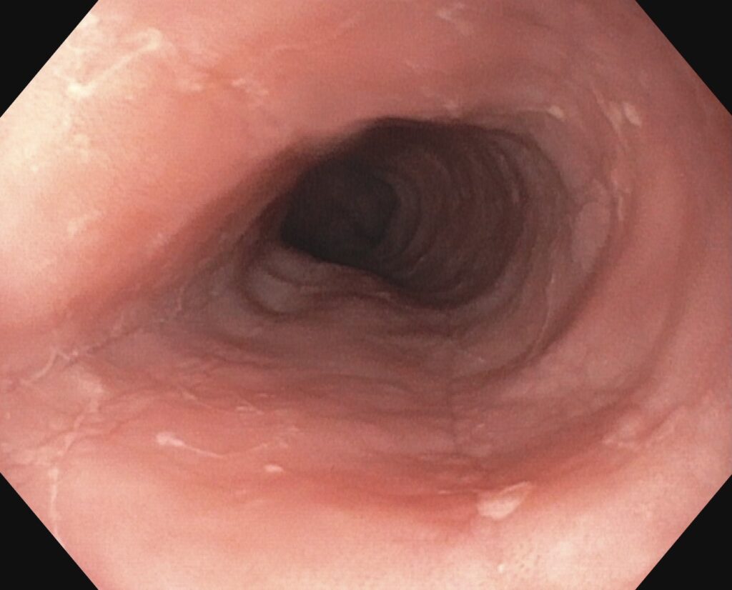 Eosinophile Ösophagitis - weißliche Exsudate