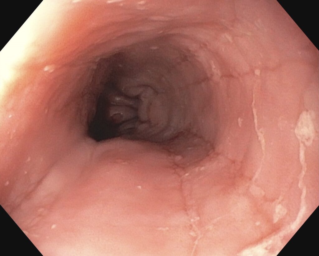 Eosinophile Ösophagitis