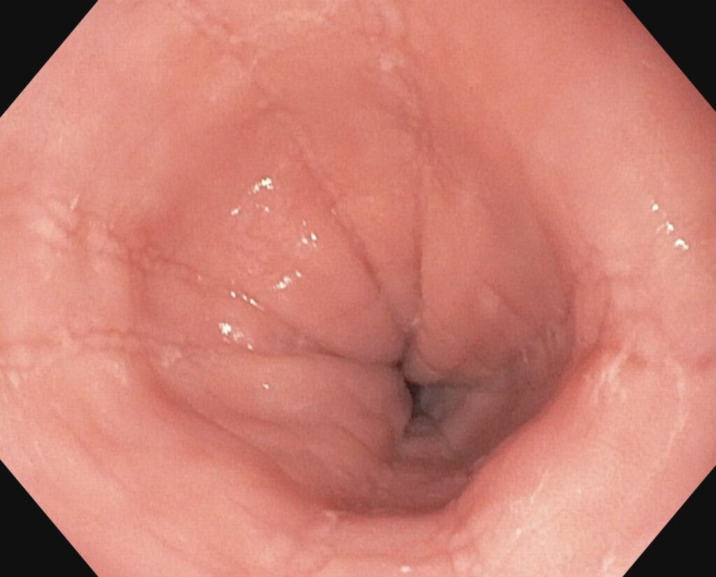 Eosinophile Ösophagitis - Längsfurchen