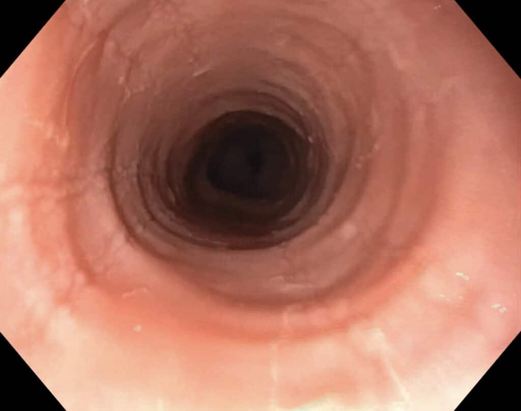 Eosinophile Ösophagitis - Ringbildung