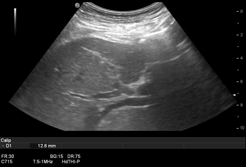 Intrahepatische Cholestase