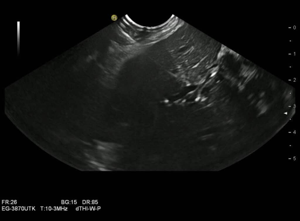 EUS-geführte Hepatikogastrostomie