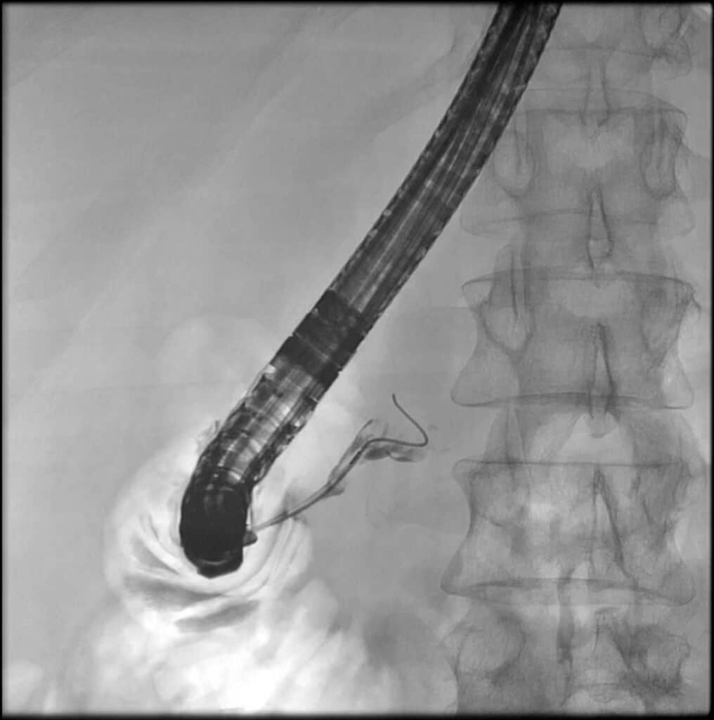 IPMN, Intraduktale papillär-muzinöse Neoplasie, Pankreastumor, Pankreaskarzinom, zystischer Pankreastumor, Doppelgangzeichen, Cholestase, ERCP, Pankreatikographie