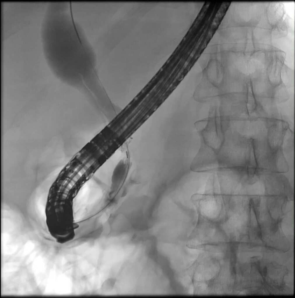 IPMN, Intraduktale papillär-muzinöse Neoplasie, Pankreastumor, Pankreaskarzinom, zystischer Pankreastumor, Doppelgangzeichen, Cholestase, ERCP, Pankreatikographie