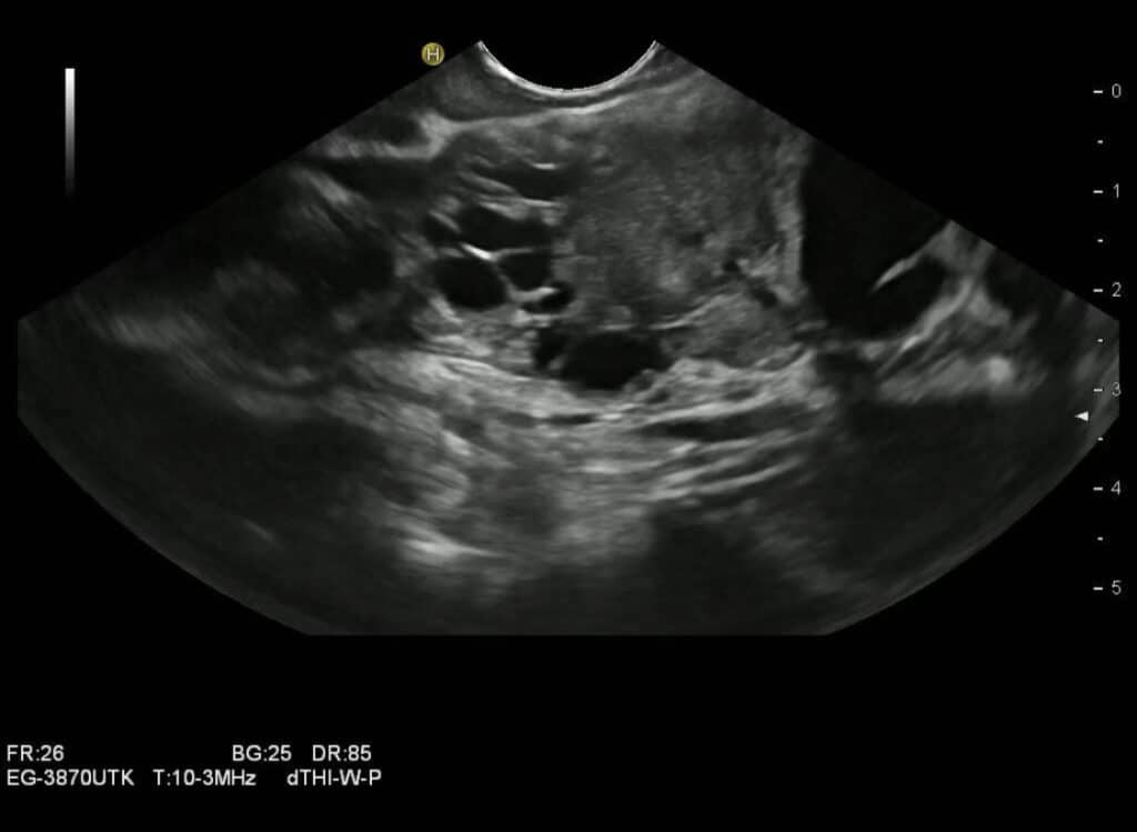 IPMN, Intraduktale papillär-muzinöse Neoplasie, Endosonographie, Pankreastumor, zystischer Pankreastumor, Doppelgangzeichen