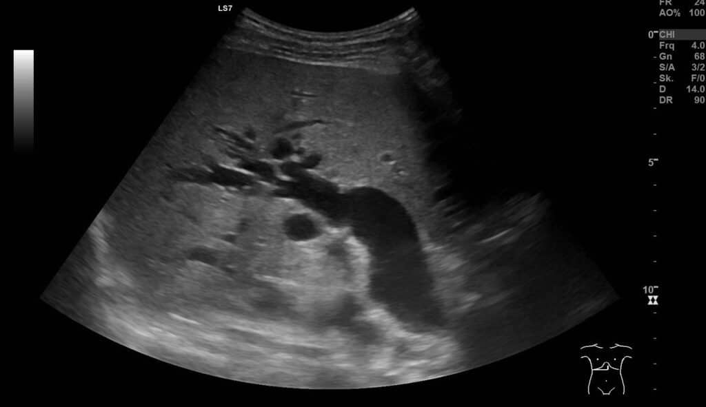 IPMN, Intraduktale papillär-muzinöse Neoplasie, Pankreastumor, Pankreaskarzinom, zystischer Pankreastumor, Doppelgangzeichen, Cholestase, Ultraschall