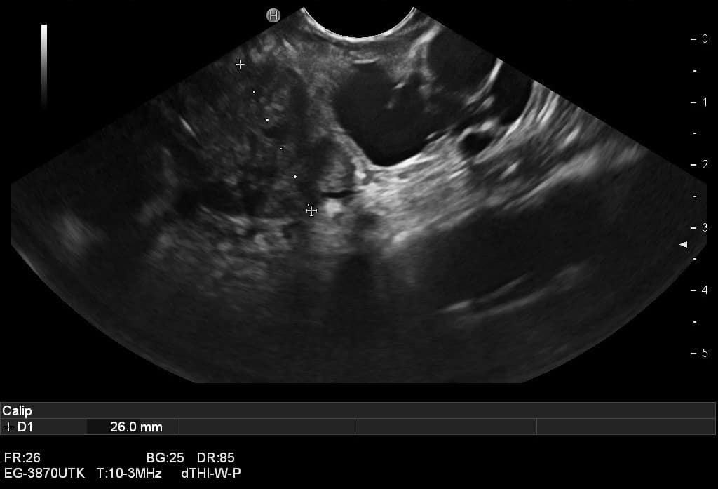 IPMN, Intraduktale papillär-muzinöse Neoplasie, Endosonographie, Pankreastumor, Pankreaskarzinom, zystischer Pankreastumor, Doppelgangzeichen