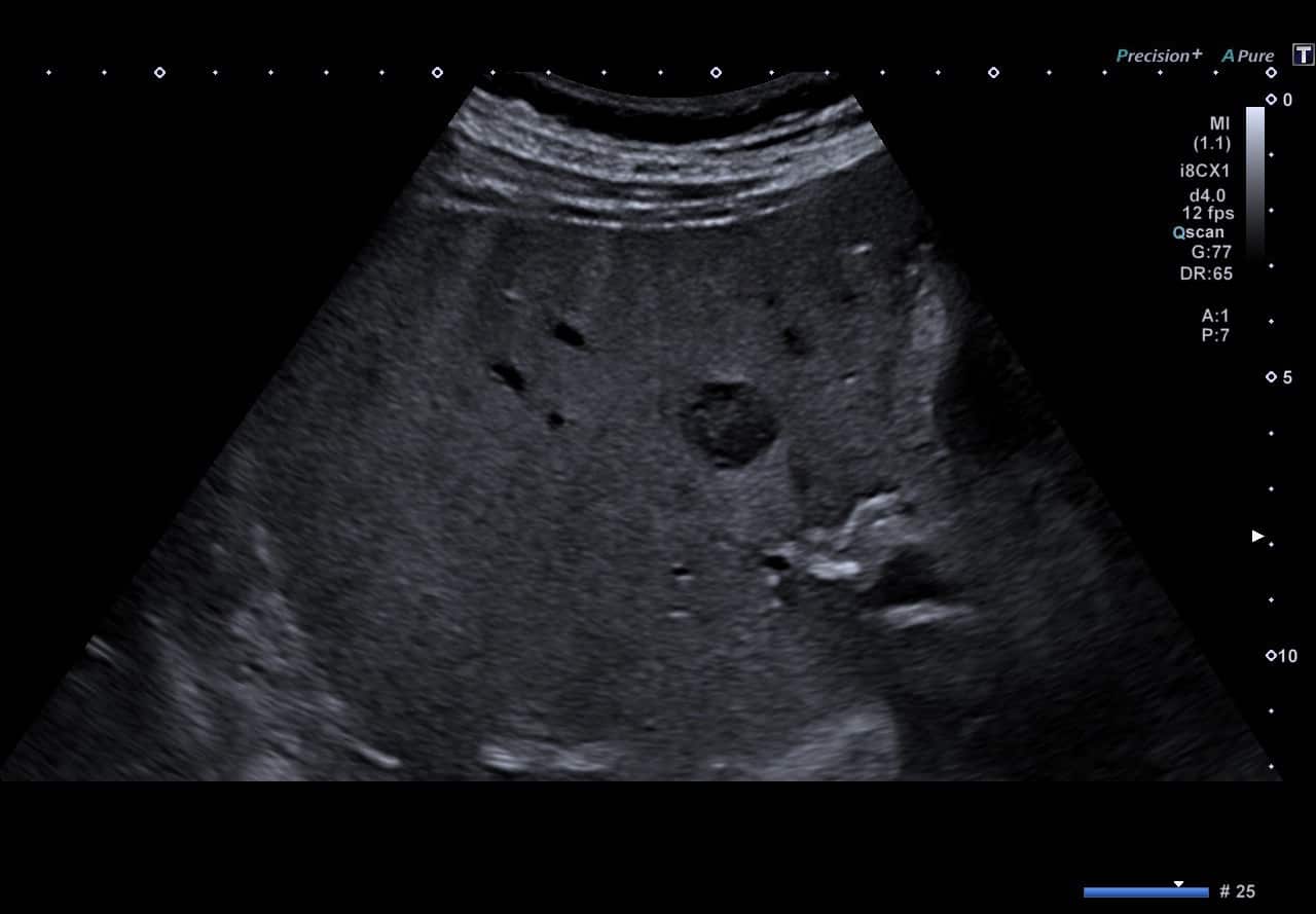 Fokale noduläre Hyperplasie (FNH) EUS and more