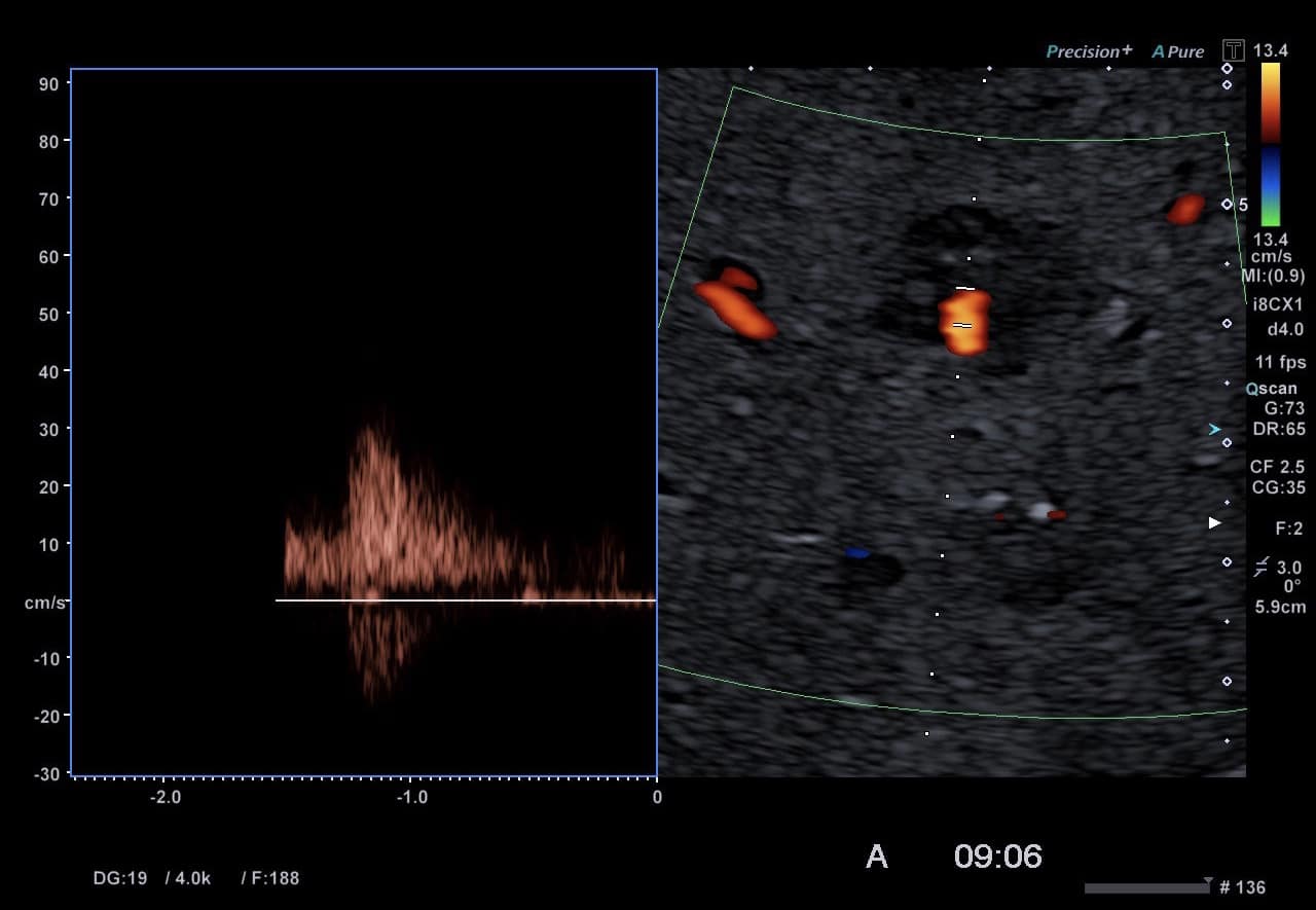 Fokale noduläre Hyperplasie (FNH) EUS and more